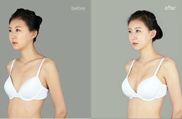 antes y despues del aumento mamario plastico