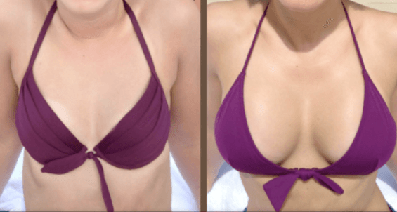 Antes y después de la cirugía de aumento de senos