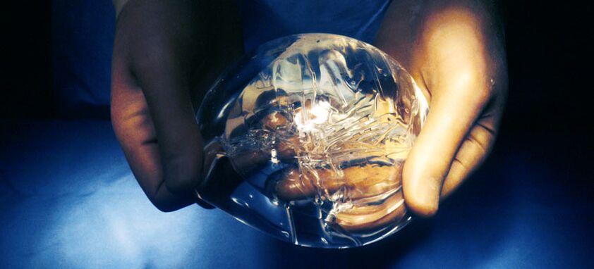 Endoprótesis de silicona