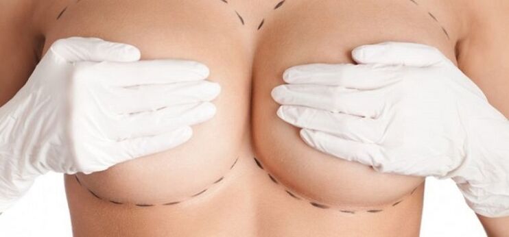 Aumento de senos mediante cirugía