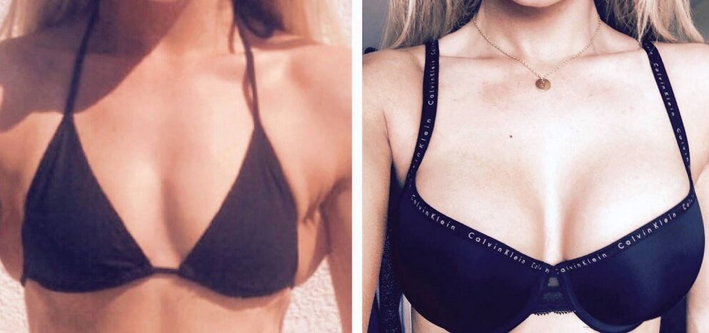 Antes y después del aumento de senos