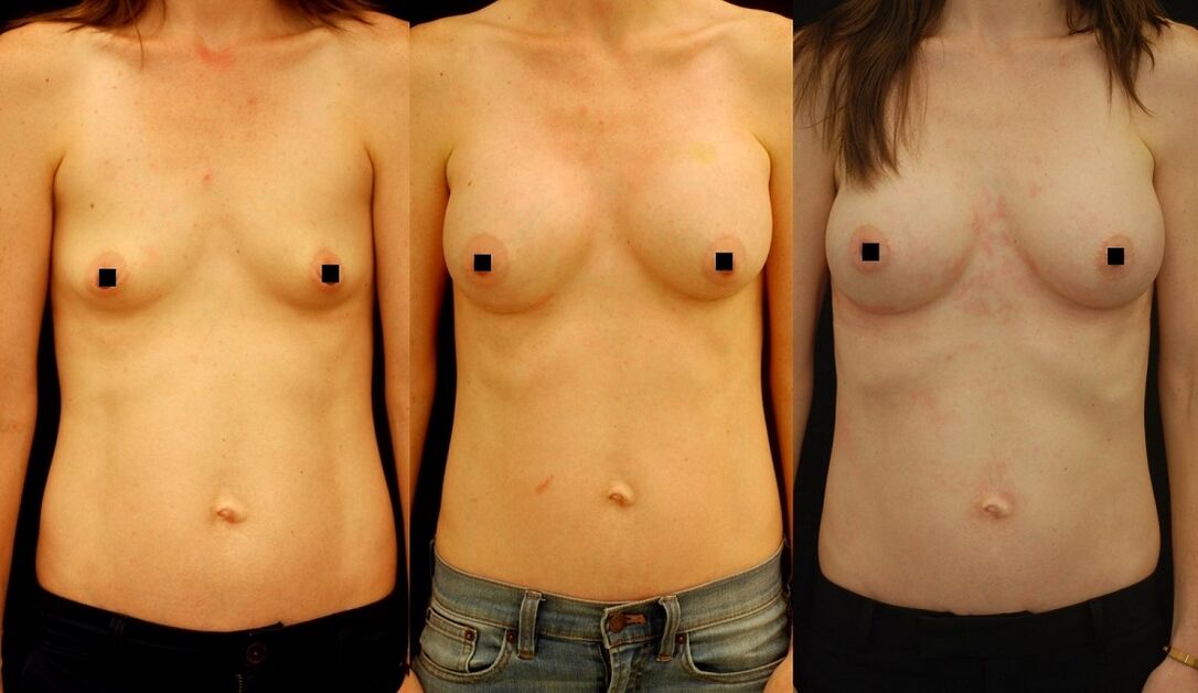 El resultado del aumento de senos por inyección. 